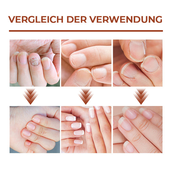 7 Tage Nagelwachstums- und Stärkungsserum